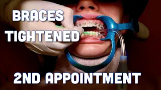 Getting my Braces tighten - 2nd appointment