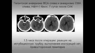 САК и инсульт, интенсивная терапия и нейропротекция (2 МСН) Савин И.А.