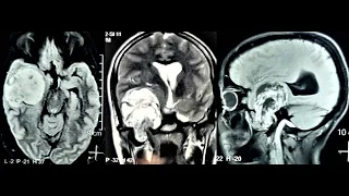 LARGE MULTI COMPARTMENTAL TRIGEMINAL SCHWANNOMA-MICROSURGERY-dr suresh dugani/HUBLI/KARNATAKA/INDIA