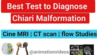 Chiari Malformation Brain MRI |Radiology | Arnold chiari malformation Ultrasound