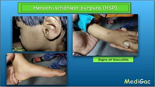 Henoch-Schonlein Purpura(HSP) - Clinical features || Pathophysiology || Diagnosis and Treatment