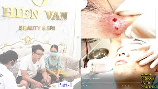 Remove and Clean many Cyst in younger at Hien Van Spa|345|Hồng lai