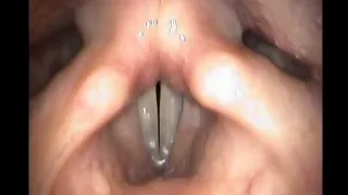 Upper Airway Anatomy During Trans-Nasal Endoscopy (HD)