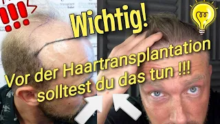 3 wichtige Dinge  vor deiner Haartransplantation!😱