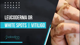 Leucoderma or White Spots | Vitiligo - Symptoms and causes