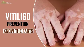 Vitiligo Disease: Types, Symptoms, Causes Treatment and Recovery | What is Vitiligo Disease?