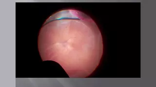 Lecture: Surgery for Retinal Detachment: Dr. Manish Nagpal