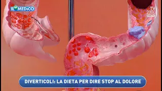 Il Mio Medico (Tv2000) - Diverticoli, la dieta per dire stop al dolore