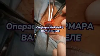 Варикоцеле! Операция по МарМару!