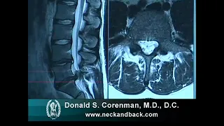 How to Read a MRI of a Lumbar Herniated Disc  Lower Back Pain  Colorado Spine Surgeon