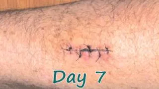 Time Lapse Recovery from Forearm Surgery