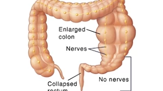 Hirschsprung Disease