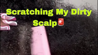 Dry Scalp ! Flakes Everywhere 😱 Mini Dandruff Scratch Vid