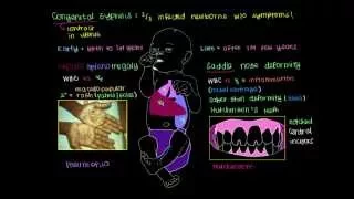 What is Congenital Syphilis?