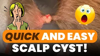 QUICK AND EASY SCALP CYST!