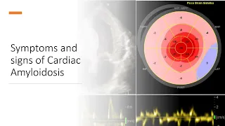 Overview of cardiac amyloidosis by Saddam Abisse MD FACC FASE Ellis Hospital
