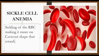 SICKLE CELL ANEMIA