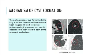 Cystic lung diseases-what may be the presentations