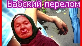 Бабский перелом