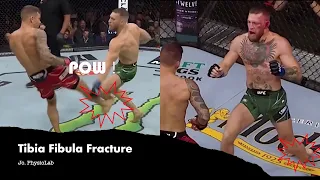 Sport Injury : Fracture of Tibia & Fibula (Conor McGregor) Shinbone broken