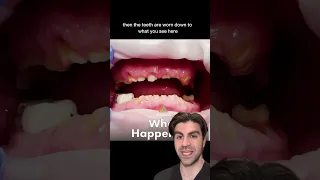 Full Mouth Of Br0ken Teeth