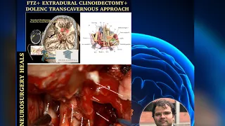 Extradural Clinoidectomy with Dolenc Transcavernous approach for Recurrent Giant Pituitary tumor