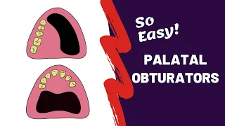 PROSTHODONTICS | What is Palatal Obturator?