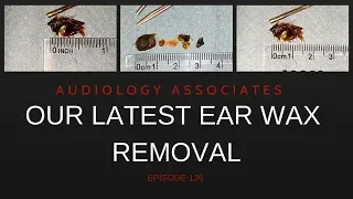 OUR LATEST EAR WAX REMOVAL COMPILATION - EP 126