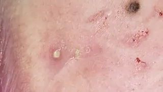 Satisfying Blackheads Removal with NasaPham SPA #30