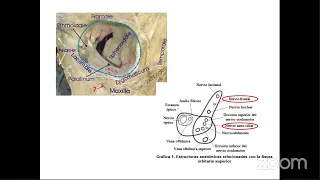 Describe the typical features and couses of cavernous sinus syndrome