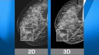 Breast Cancer Easier to Spot With New Technology