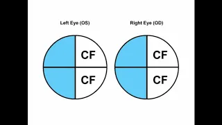 RS Visual Fields Part 1 - Performing The Tests