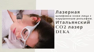 Лазерная шлифовка кожи лица с нарушенным рельефом. Итальянский CO2 лазер DEKA.