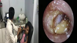 Best ear wax removal ever | How to remove earwax | EXTRA large ear wax in small child