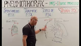Tension Pneumothorax | Diagnosis & Management🩺