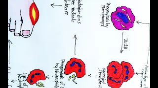 Acute gouty arthritis: Risk factors, Pathogenesis , Clinical features and Treatment