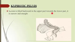 Contracted pelvis - Metro College of Nursing