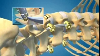 XLIF / DLIF Minimally Invasive Spine Surgery for Back Pain Animation - Dr. Neel Anand