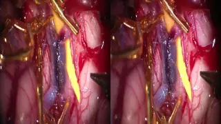 PICA-to-PICA In Situ Bypass Management for Ruptured PICA Aneurysm