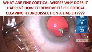 From Good To Great #4: Fine Cortical Wisps. How?Why? Cortical Cleaving Hydrodissection a Liability?