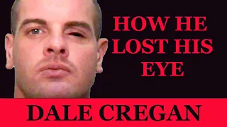 Dale Cregan - How He Lost His Eye