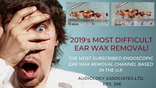 2019's MOST DIFICULT EAR WAX REMOVAL - EP 266