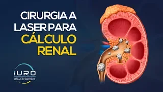 Cirurgia a Laser para CÁLCULO RENAL (Pedra nos rins)