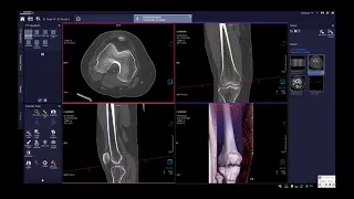 طريقة عمل فحص الاشعة المقطعية على الركبة بالتفصيل CT KNEE