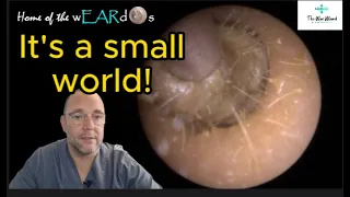 It's a small world! 176 #ear #earwax #earwaxremoval #earcleaning  #asmr #asmrearwax #satisfying