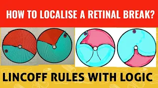 How to localise a retinal break in retinal detachment || lincoff rules||