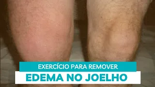 Exercício para tratar o edema do joelho quando ele fica inchando