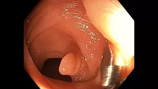 Polyp-diverticulum in the sygmoid colon