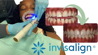 Q/A INVISALIGN | 10 Things you MUST Know | Invisalign Before and After | MY INVISALIGN JOURNEY