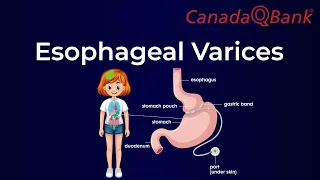 Esophageal Varices